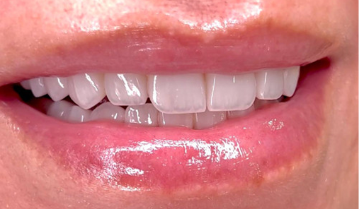 Ceramic Braces after